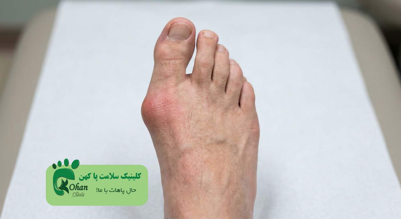 انحراف شست پا (Halux-valgus)