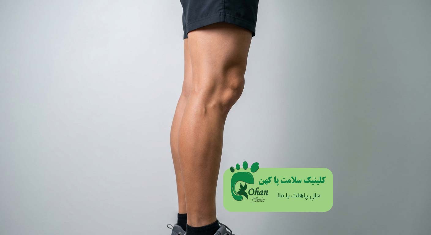 عقب زدگی زانو