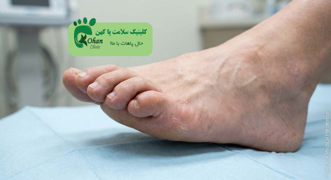 انگشت چنگکی