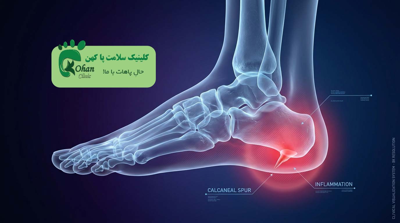 خارپاشنه