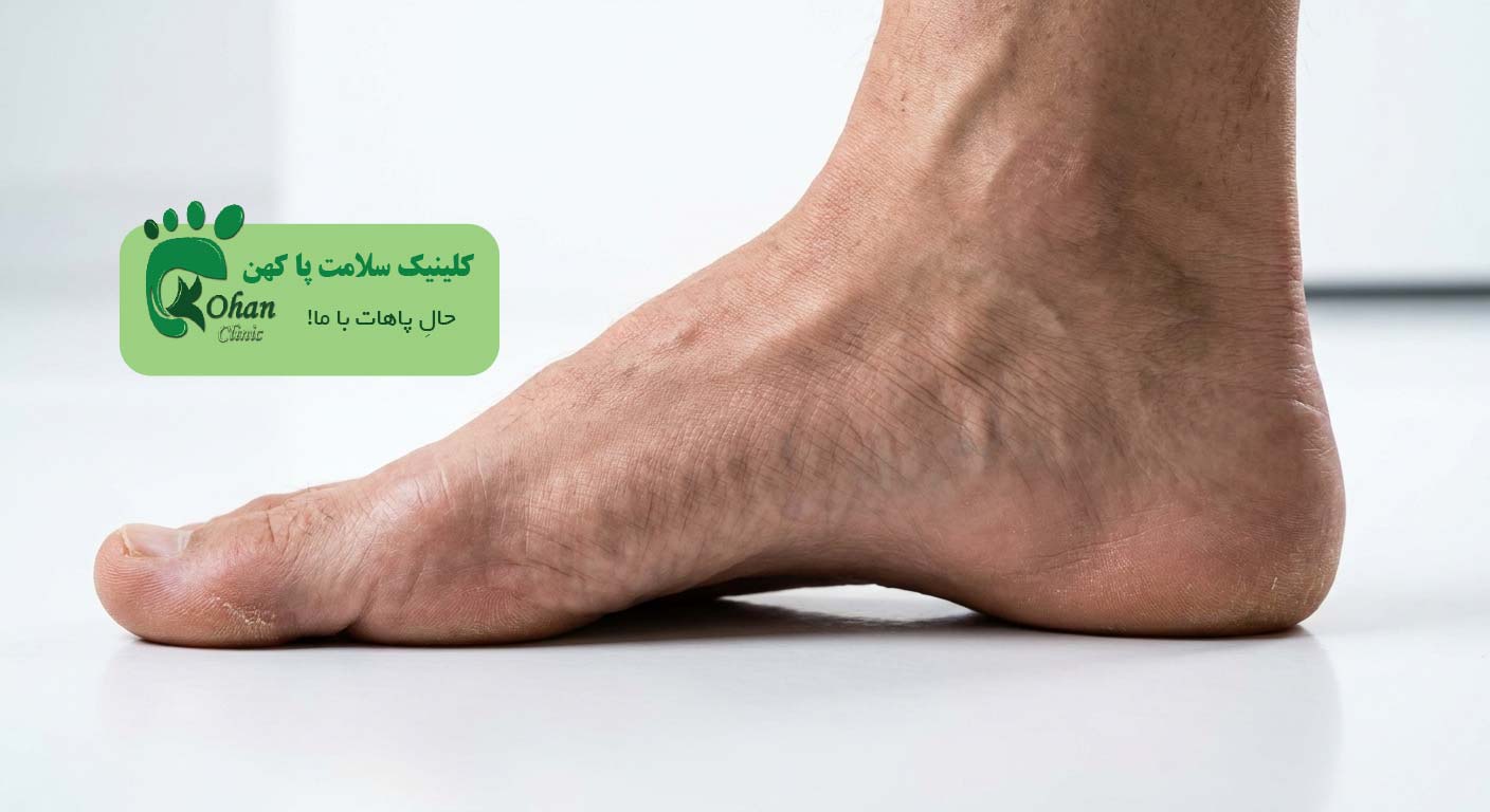 قوس زیاد پا (گودی کف پا)