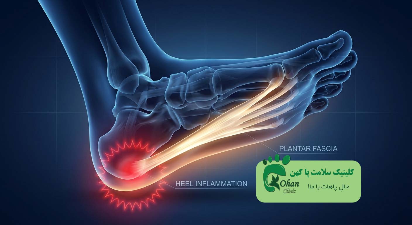 التهاب فاسیای کف پا